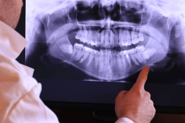 Best Emergency Wisdom Teeth Removal in Moonachie, NJ